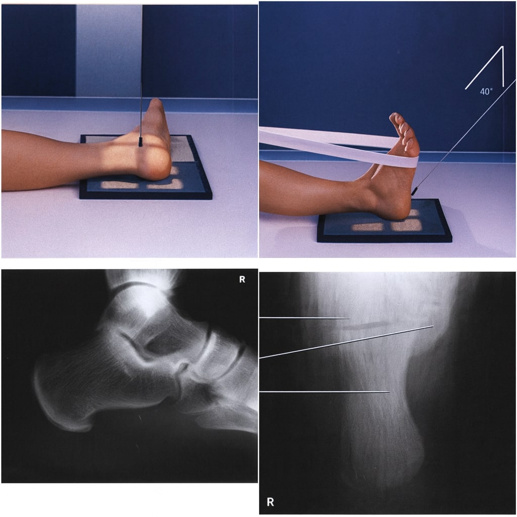 Calcaneus (Tumit)