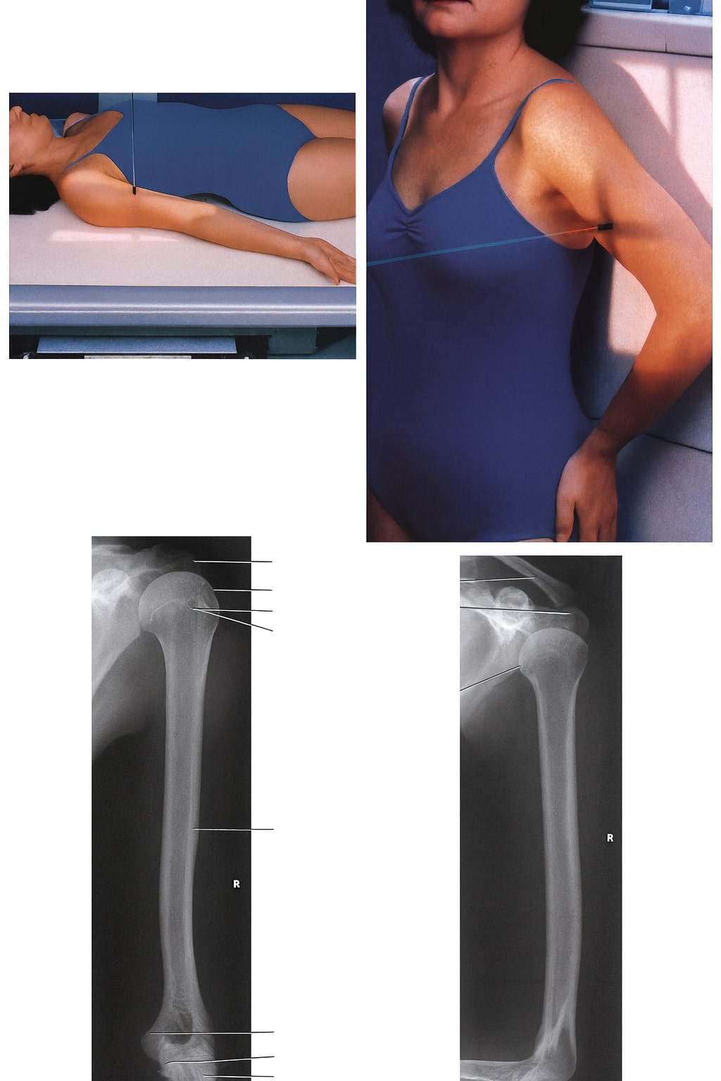 Humerus (Lengan Atas)