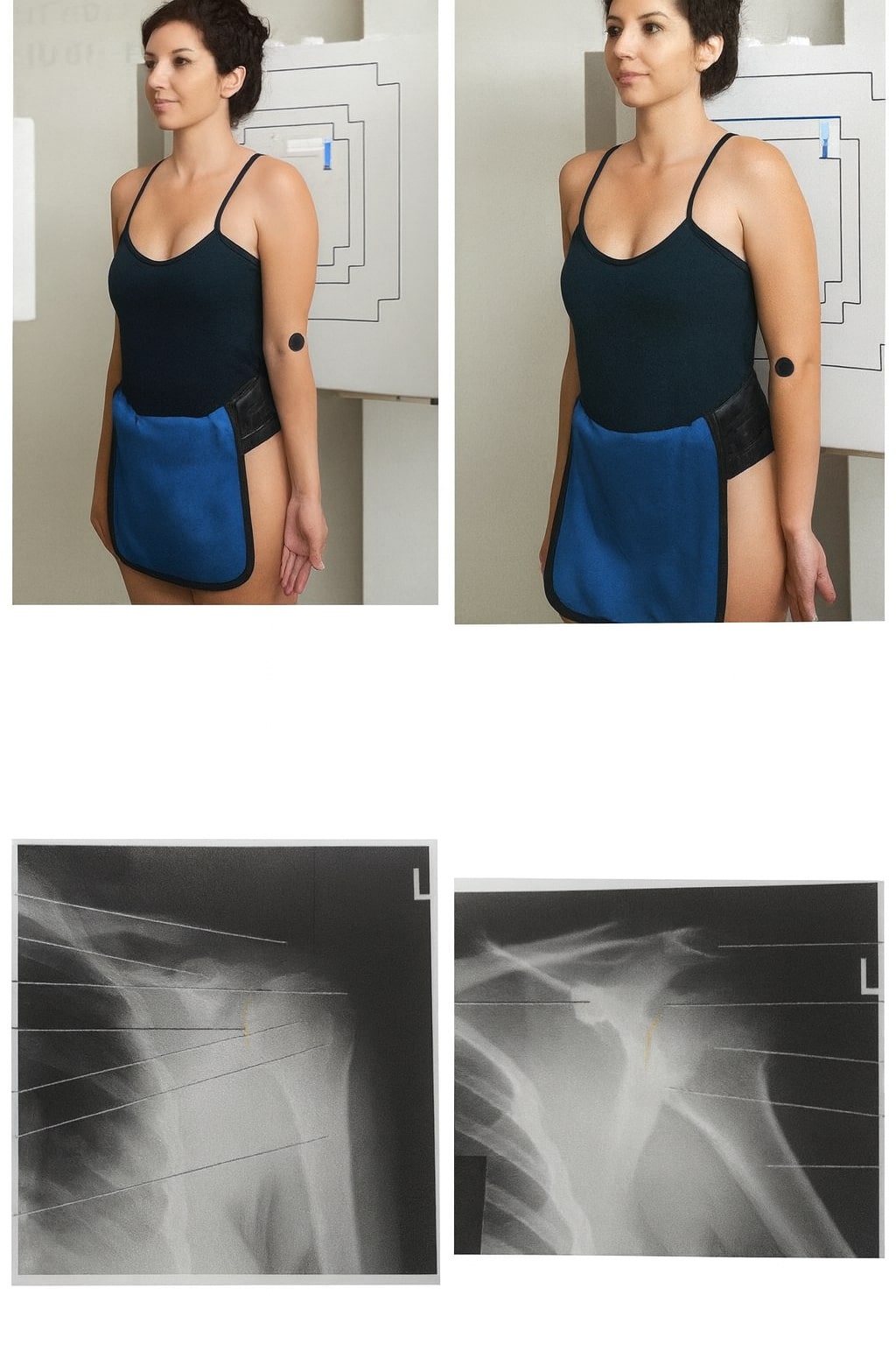 Shoulder Joint (Bahu)